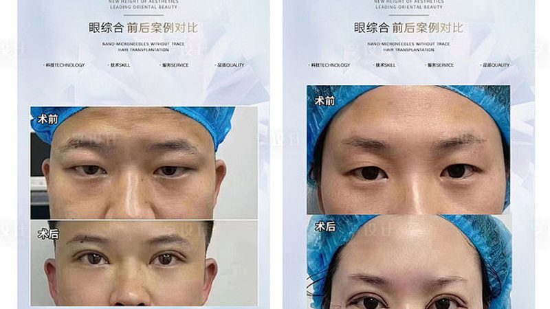 超声炮美容院设备：揭秘性价比之选