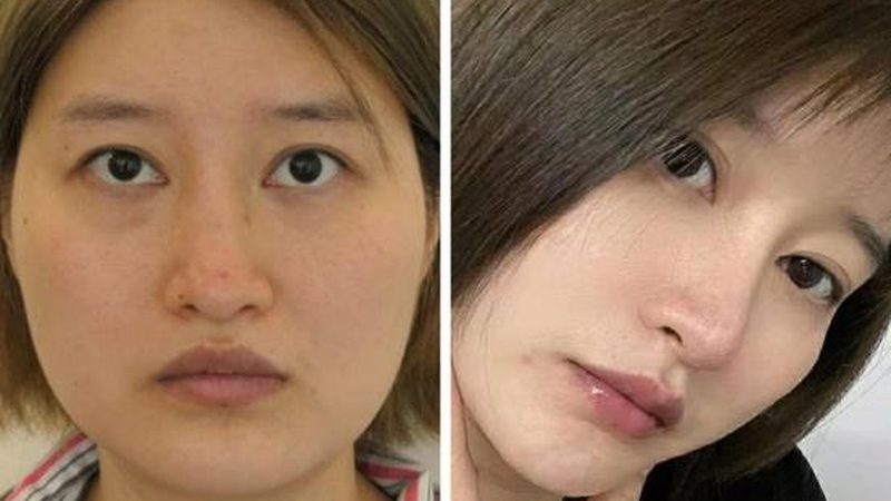 面部年轻化注射方案，如何精准选择？**