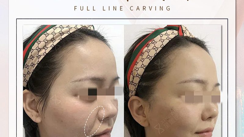 注射美容，如何选择适合自己的价格套餐？**