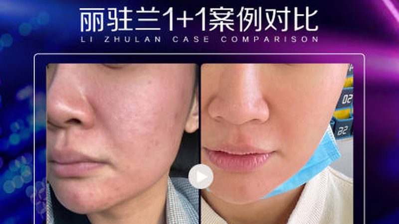 广州隆鼻，这几点注意事项你不得不知