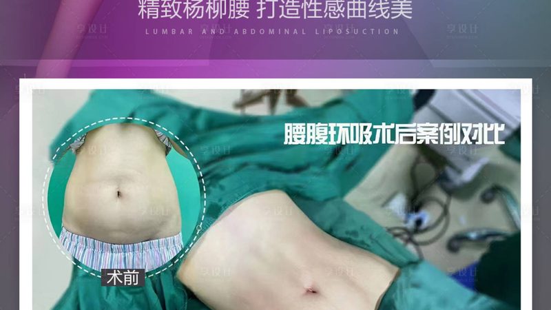 A型肉毒素是目前应用最广泛的型号，如我国批准的保妥适、路德维等。它具有以下特点：