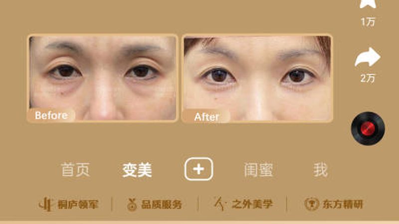 面部线雕提升，真的没有后遗症吗？**